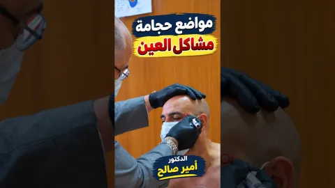 مواضع حجامة مشاكل العين