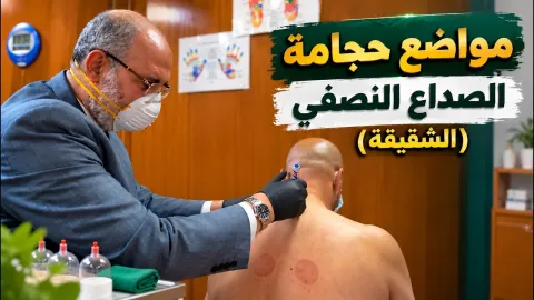 مواضع حجامة الصداع النصفي (الشقيقة )