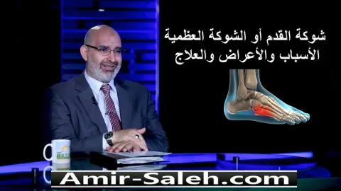 شوكة القدم أو الشوكة العظمية .. الأسباب والأعراض والعلاج  | الطب الآمن