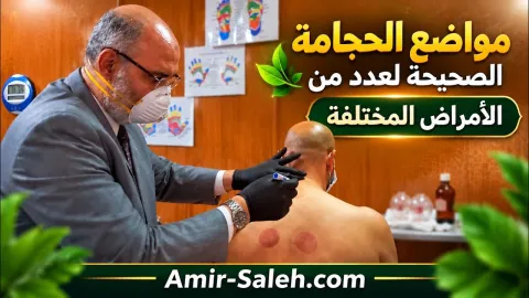 مواضع الحجامة الصحيحة لعدد من الأمراض المختلفة